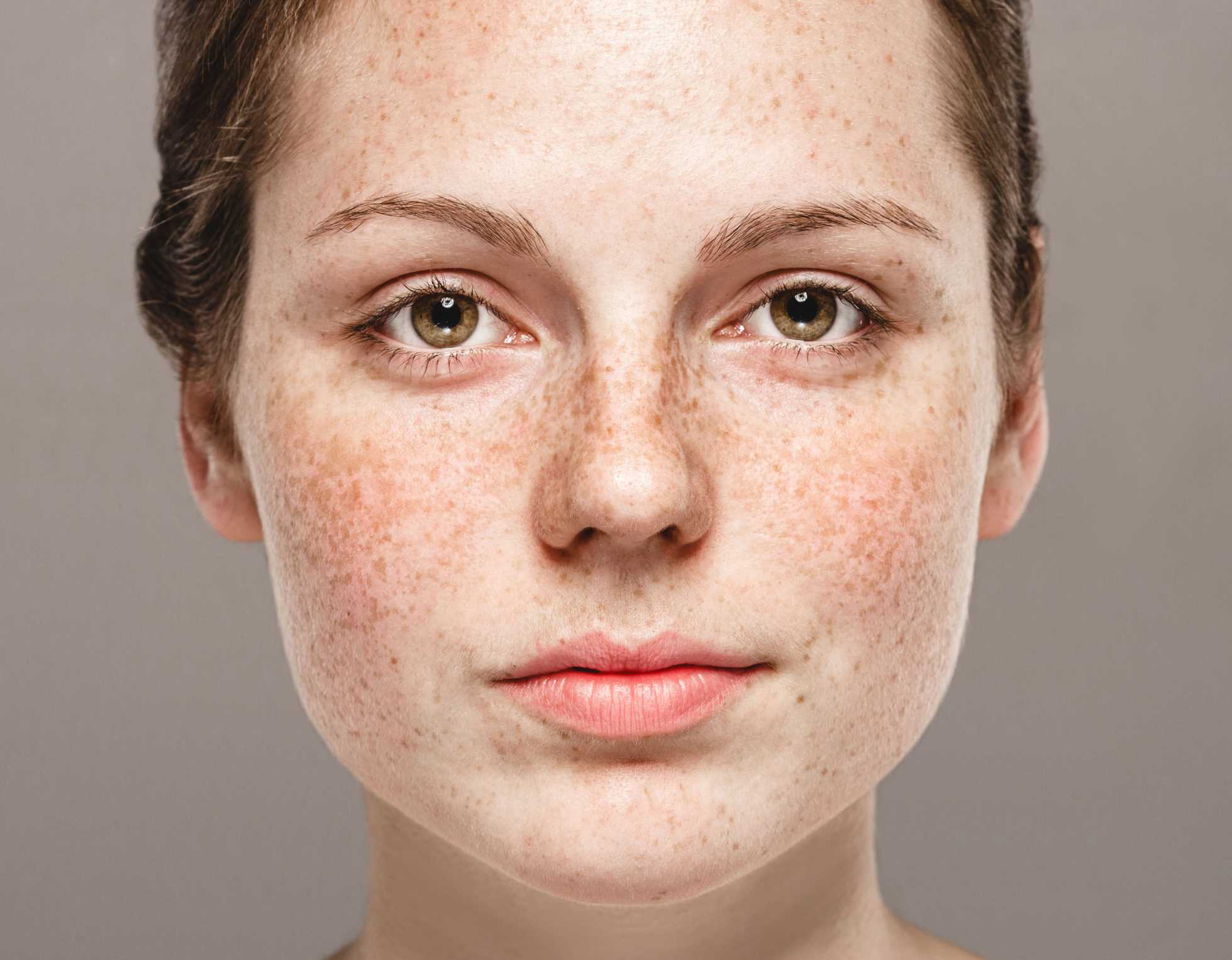What you need to know about hyperpigmentation: types, causes, treatments – Jioforme
