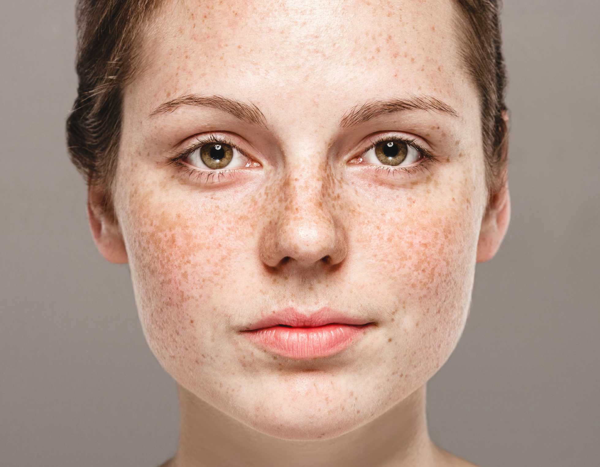 What you need to know about hyperpigmentation: types, causes, treatments –  Jioforme